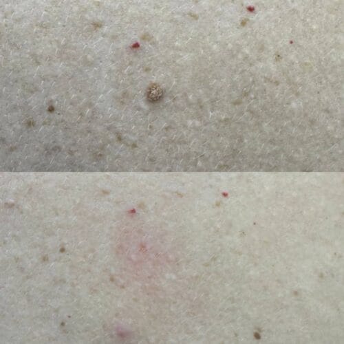 Лазерное удаление новообразований в Киеве от клиники Platinum Laser Лазерное удаление новообразований до и после фото 52