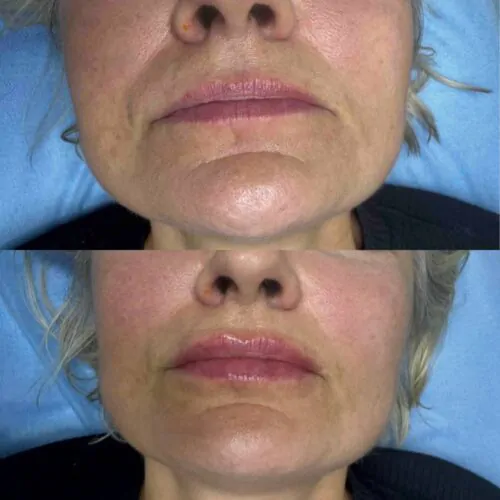 УВЕЛИЧЕНИЕ ГУБ ГИАЛУРОНОВОЙ КИСЛОТОЙ в Киеве от клиники Platinum Laser УВЕЛИЧЕНИЕ ГУБ ГИАЛУРОНОВОЙ КИСЛОТОЙ до и после фото 67