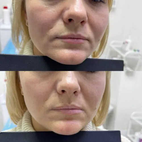 Контурная пластика лица до и после фото 21