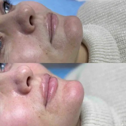 Контурная пластика лица до и после фото 22