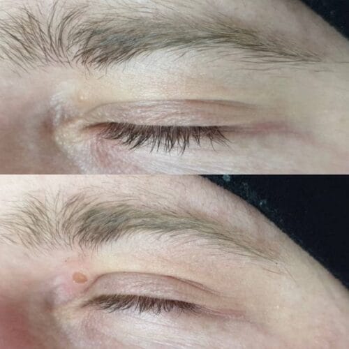 Лазерное удаление новообразований в Киеве от клиники Platinum Laser Лазерное удаление новообразований до и после фото 70