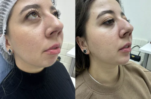 Контурная пластика лица до и после фото 17