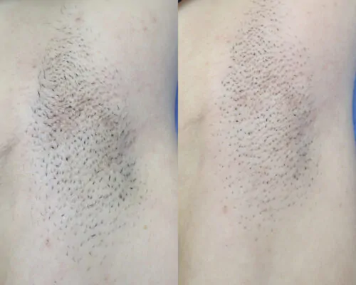 ЛАЗЕРНАЯ ЭПИЛЯЦИЯ НЕОДИМОВЫМ ЛАЗЕРОМ в Киеве от клиники Platinum Laser ЛАЗЕРНАЯ ЭПИЛЯЦИЯ НЕОДИМОВЫМ ЛАЗЕРОМ до и после фото 1