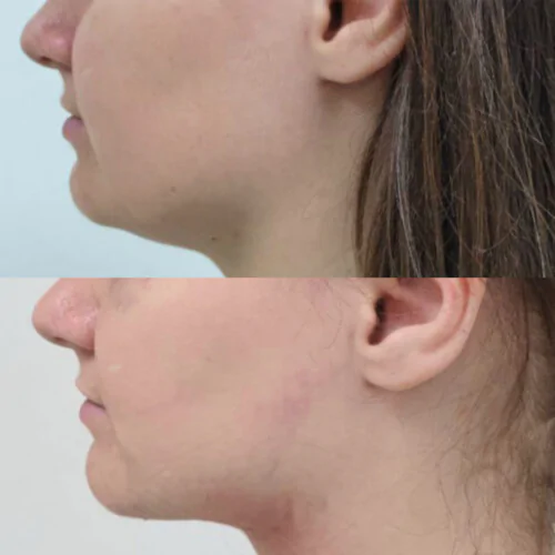 ЛАЗЕРНАЯ ЛИПОСАКЦИЯ ЛИЦА до и после фото 5