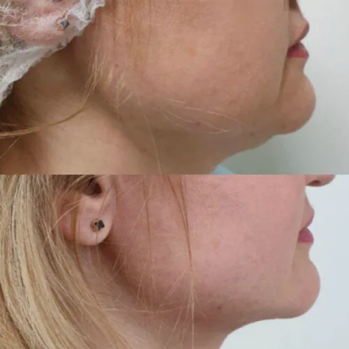 ЛАЗЕРНАЯ ЛИПОСАКЦИЯ ЛИЦА до и после фото 4