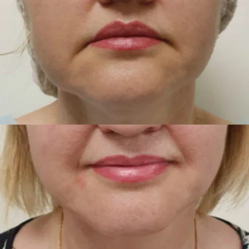 ЛАЗЕРНАЯ ЛИПОСАКЦИЯ ЛИЦА до и после фото 3