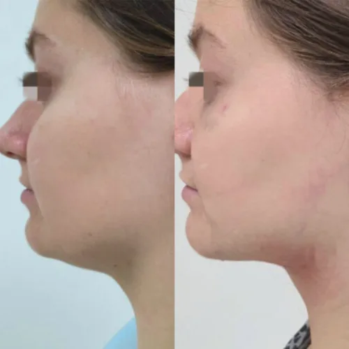 ЛАЗЕРНАЯ ЛИПОСАКЦИЯ ЛИЦА до и после фото 2