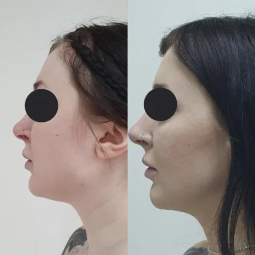 ЛАЗЕРНАЯ ЛИПОСАКЦИЯ ЛИЦА до и после фото 1