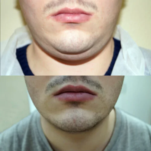 ЛАЗЕРНАЯ ЛИПОСАКЦИЯ ЛИЦА до и после фото 9