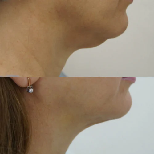 ЛАЗЕРНАЯ ЛИПОСАКЦИЯ ЛИЦА до и после фото 8