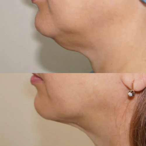 ЛАЗЕРНАЯ ЛИПОСАКЦИЯ ЛИЦА до и после фото 7