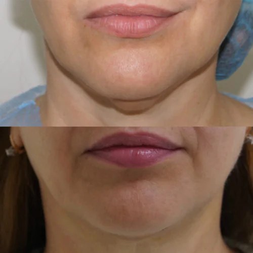 ЛАЗЕРНАЯ ЛИПОСАКЦИЯ ЛИЦА до и после фото 6