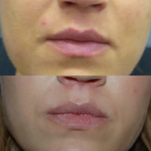 Cheiloplasty: lip plastic surgery before and after photo 1