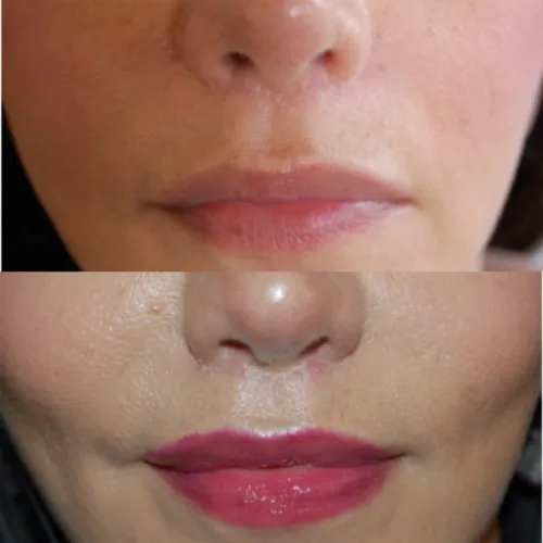 Cheiloplasty: lip plastic surgery before and after photo 2