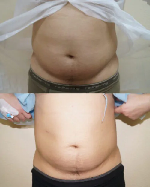 Липосакция всего тела в Киеве от клиники Platinum Laser Липосакция всего тела до и после фото 2