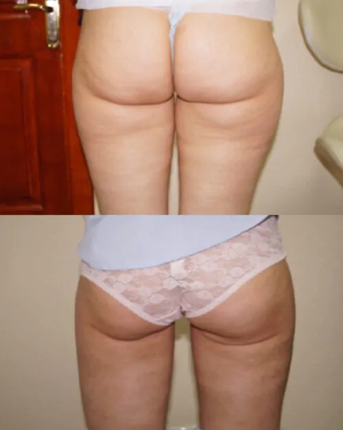 Липосакция всего тела в Киеве от клиники Platinum Laser Липосакция всего тела до и после фото 3