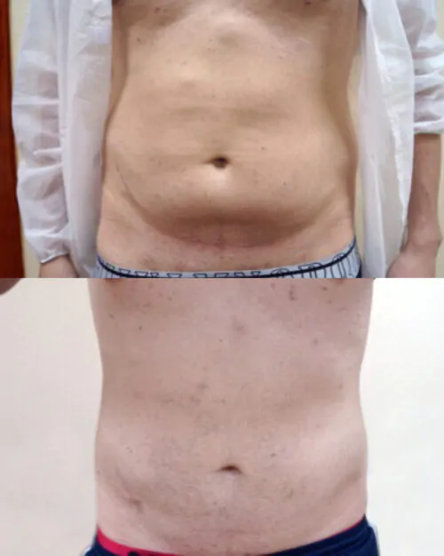 Липосакция всего тела в Киеве от клиники Platinum Laser Липосакция всего тела до и после фото 4