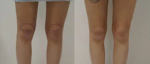 Липосакция всего тела в Киеве от клиники Platinum Laser Липосакция всего тела до и после фото 5