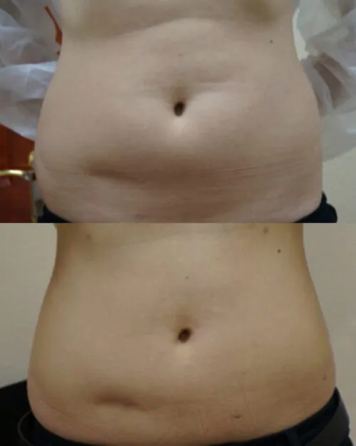 Липосакция всего тела в Киеве от клиники Platinum Laser Липосакция всего тела до и после фото 1
