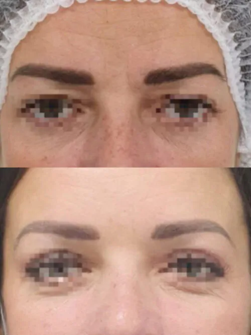 Кантопластика (изменение формы и разреза глаз) до и после фото 2