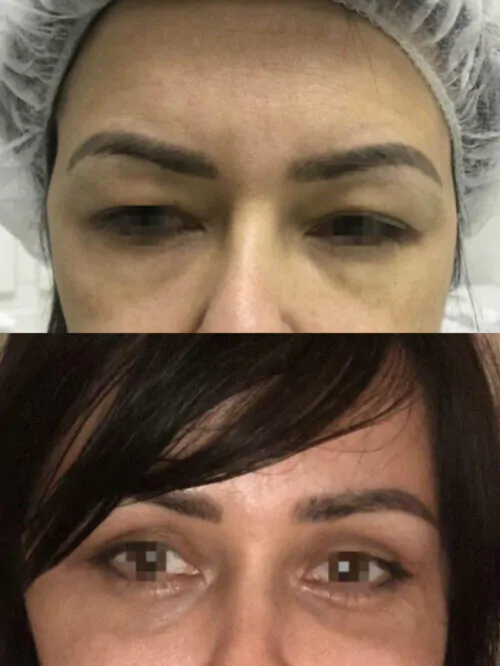 Кантопластика (изменение формы и разреза глаз) до и после фото 1