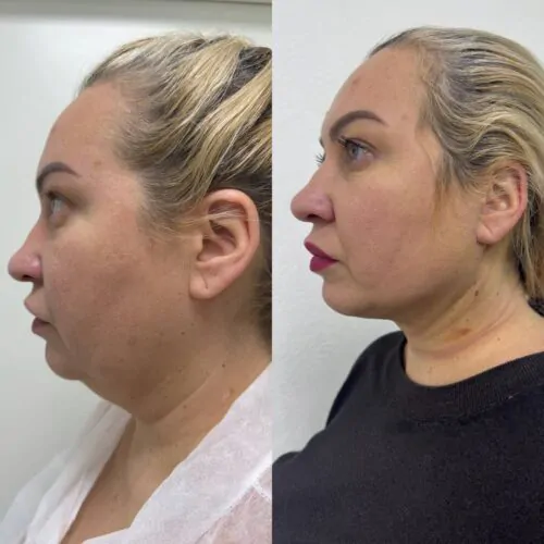 Ліпосакція підборіддя в Киеве от клиники Platinum Laser Ліпосакція підборіддя до і після фото 9