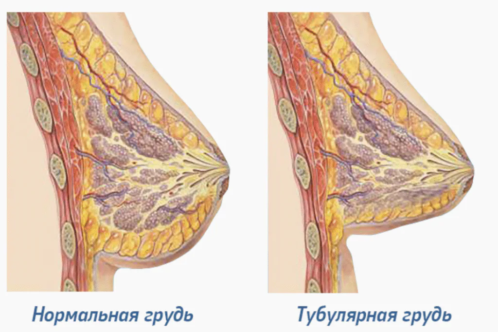 Степени тубулярности: I–III и что это значит?